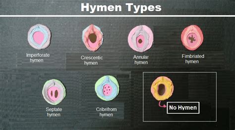 hymen pictures|Vaginal Self